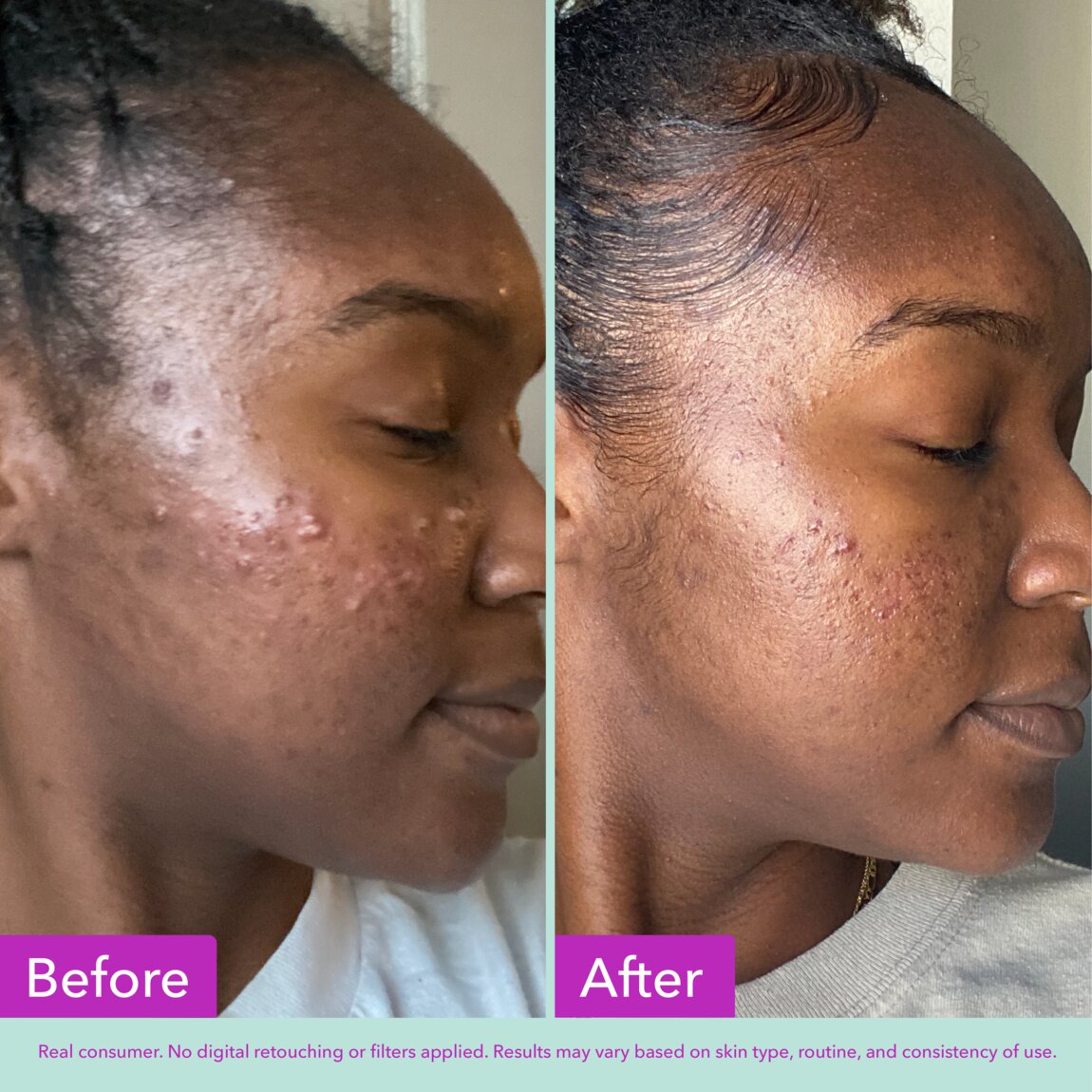 acne-foaming-cleanser-d7 zb_p.jpg